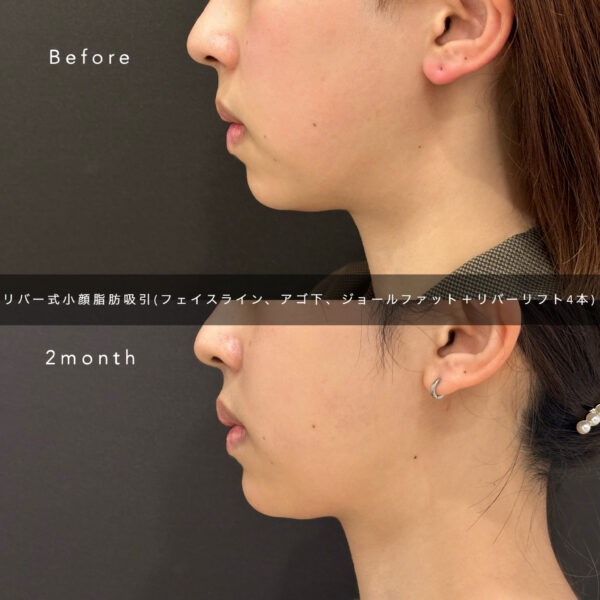 リバー式小顔脂肪吸引　70