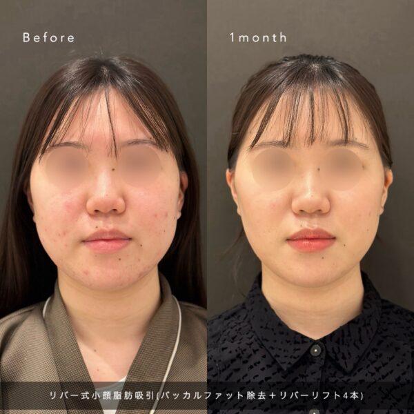 リバー式小顔脂肪吸引　72